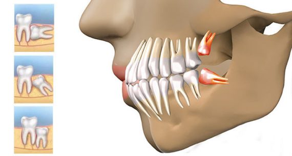 20lik diş belirtileri ağrısı nasıl geçer