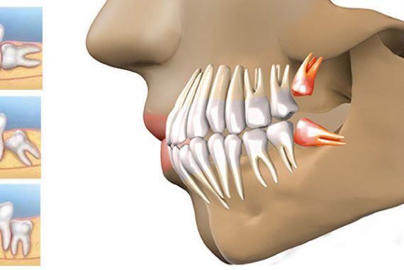 20lik diş belirtileri ağrısı nasıl geçer