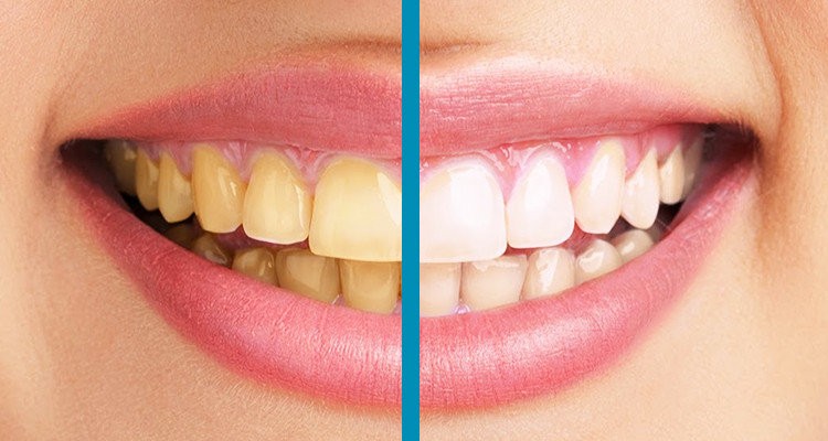 diş sararması nasıl geçer dişler neden sararır