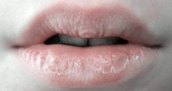 dudak kuruluğu nasıl geçer