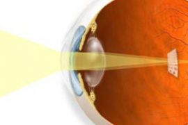 astigmat nedir, belirtileri ve tedavisi