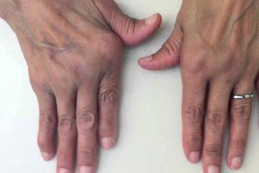 romatoid artrit nedir, belirtileri, tedavisi