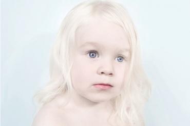 albino hastalığı nedir, neden olur, belirtileri ve tedavisi