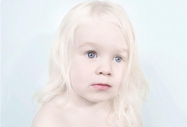 albino hastalığı nedir, neden olur, belirtileri ve tedavisi